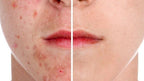 Gezichtscrub - Onzuivere huid - Acne weg - Skin Collection - afbeelding 3