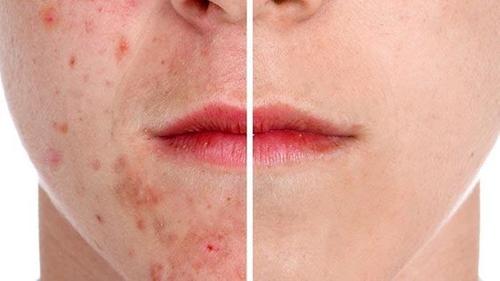 Gezichtscrub - Onzuivere huid - Acne weg - Skin Collection - afbeelding 3